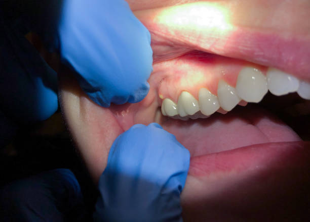 Best Emergency Wisdom Teeth Removal in Horse Shoe, NC